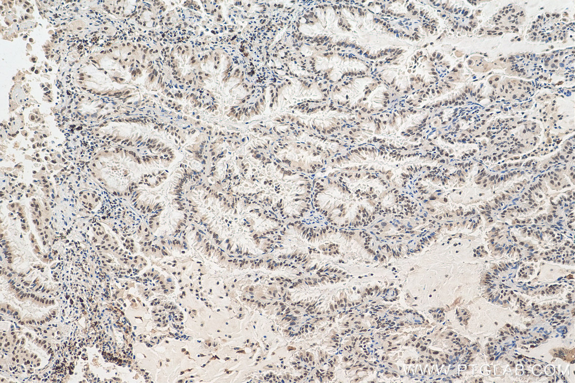 IHC staining of human lung cancer using 29303-1-AP