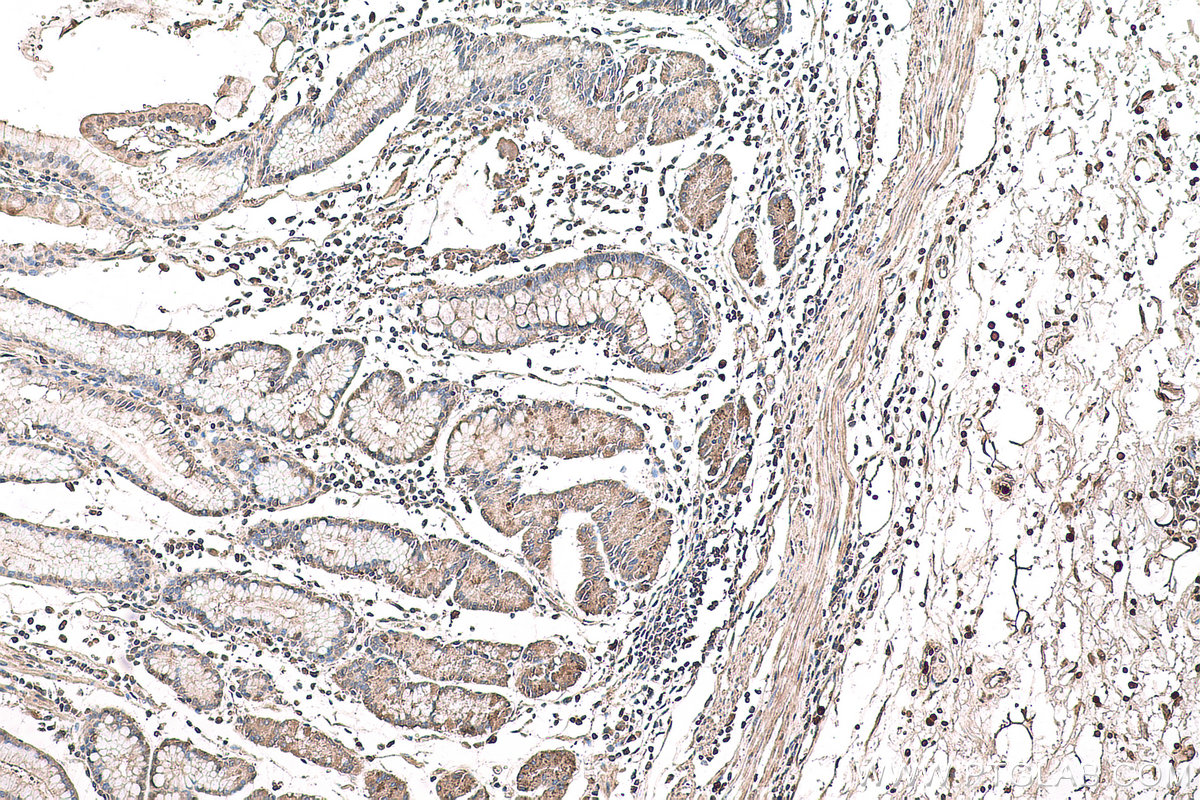 IHC staining of human stomach cancer using 19692-1-AP