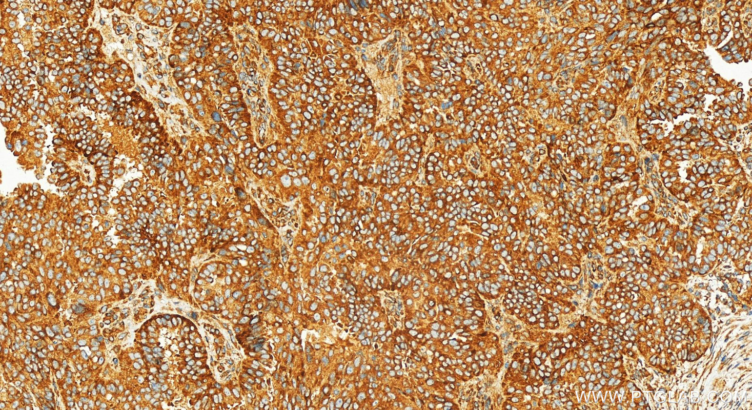 IHC staining of human ovarian  cancer using 82936-8-RR (same clone as 82936-8-PBS)