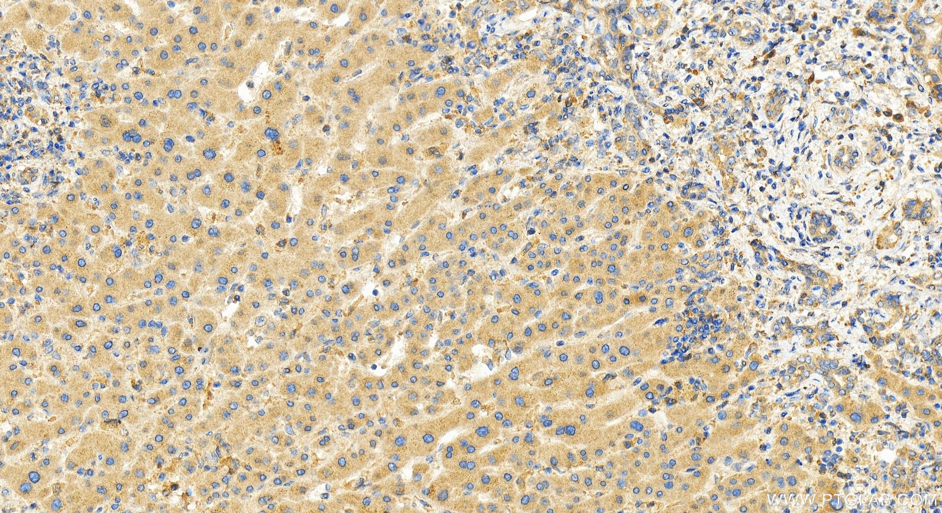 IHC staining of human intrahepatic cholangiocarcinoma using 26178-1-AP