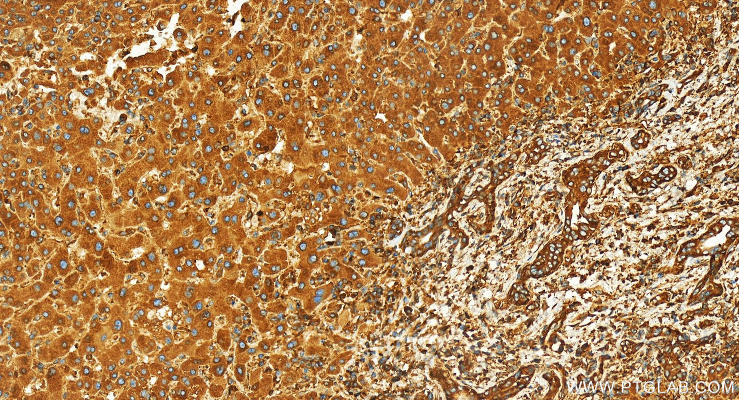 IHC staining of human intrahepatic cholangiocarcinoma using 26178-1-AP