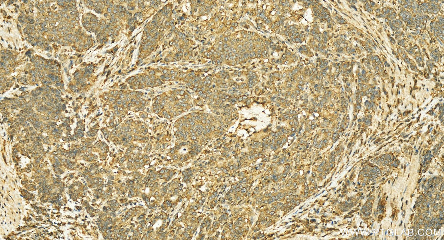 IHC staining of human stomach cancer using 12733-1-AP