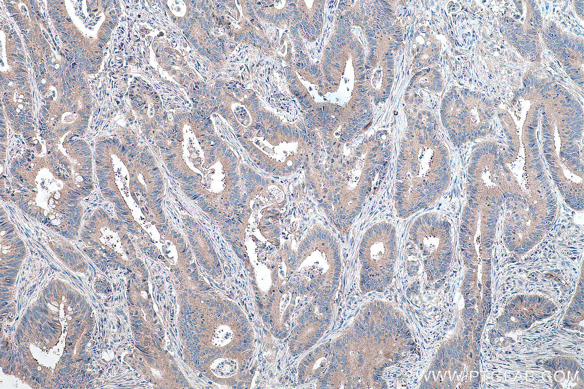 IHC staining of human colon cancer using 11165-1-AP