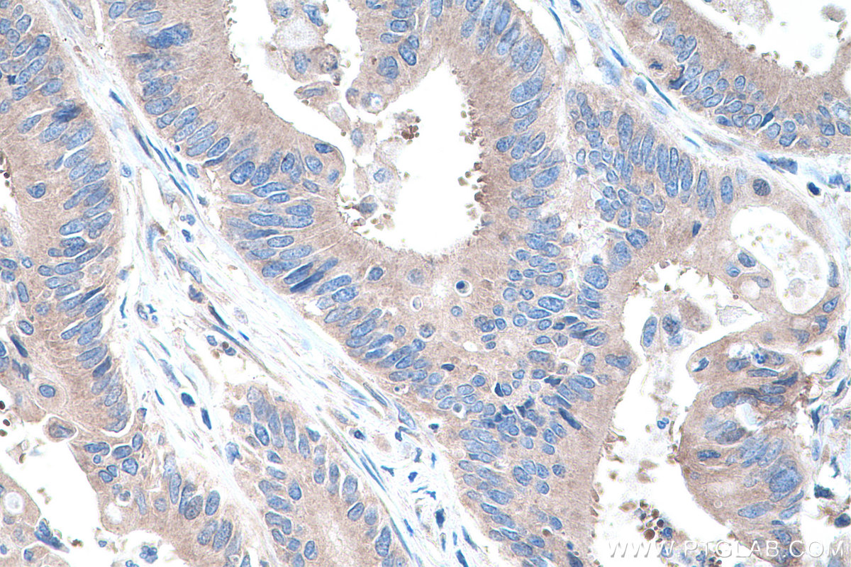 IHC staining of human colon cancer using 11165-1-AP