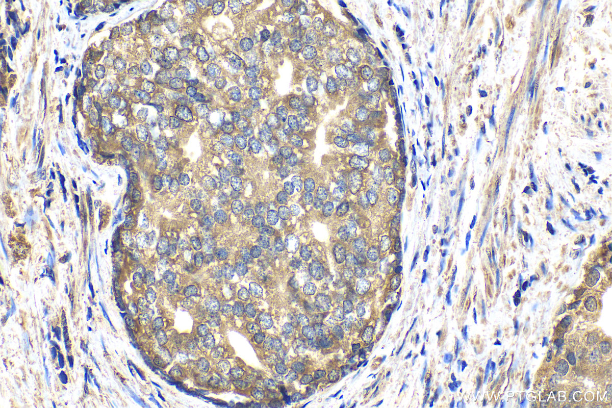 IHC staining of human prostate cancer using 17728-1-AP