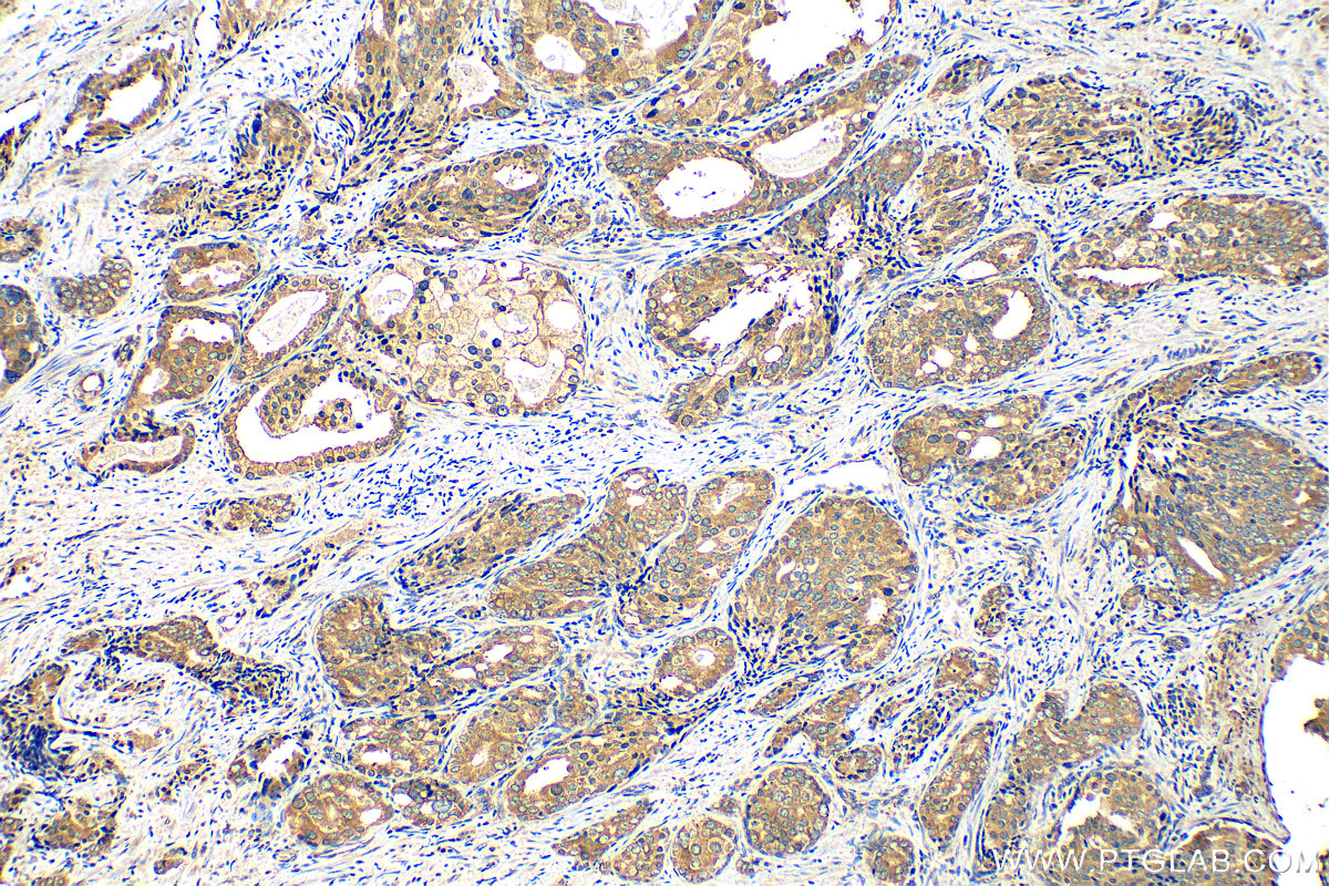 IHC staining of human prostate cancer using 67428-1-Ig (same clone as 67428-1-PBS)