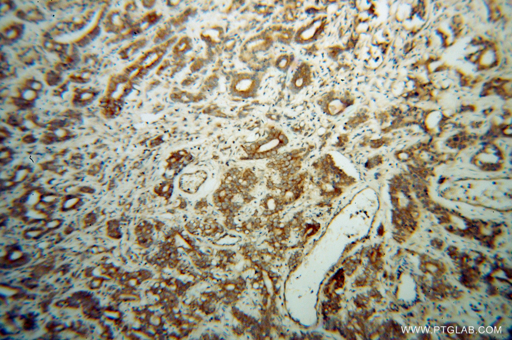 IHC staining of human gliomas using 13527-1-AP