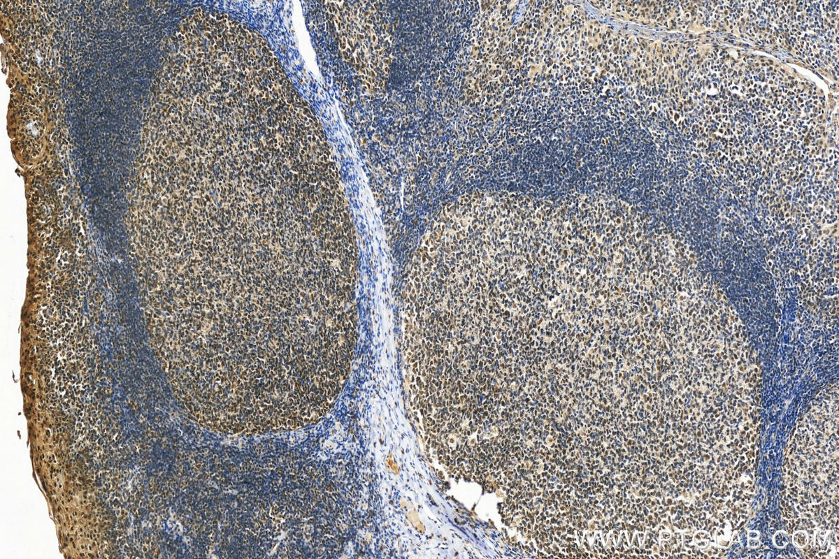 IHC staining of human tonsillitis using 22565-1-AP