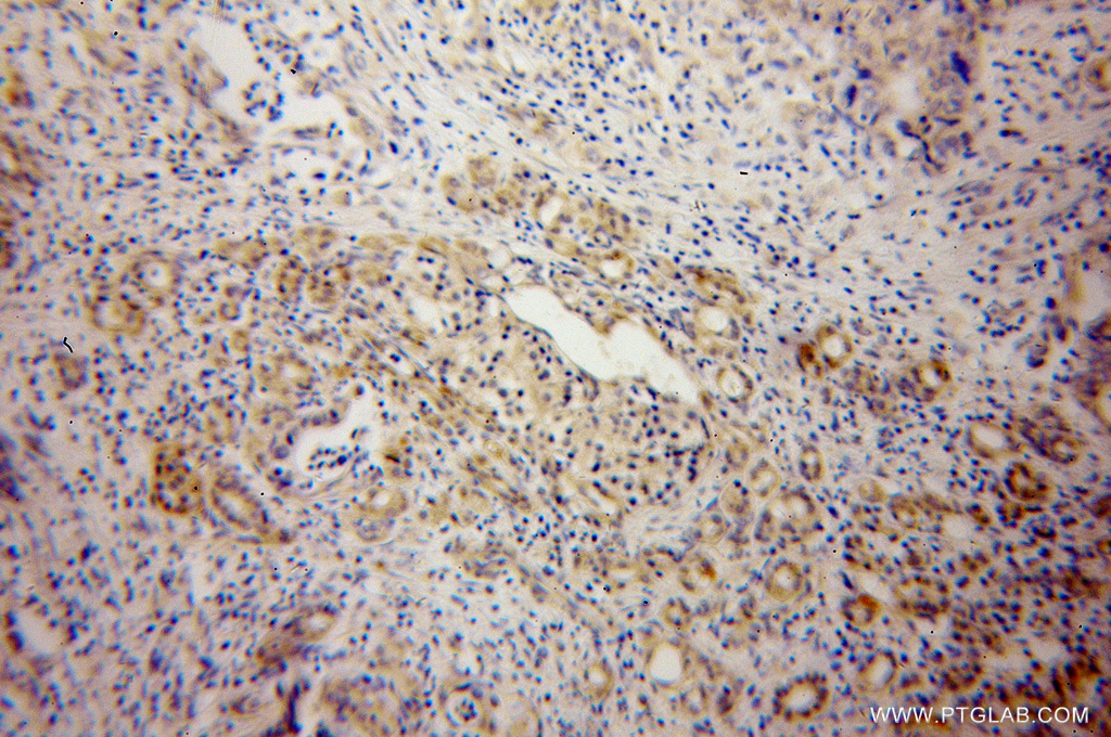 IHC staining of human pancreas cancer using 13027-1-AP