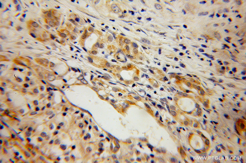 IHC staining of human pancreas cancer using 13027-1-AP