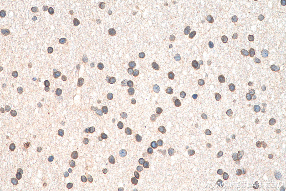 IHC staining of human gliomas using 55023-1-AP