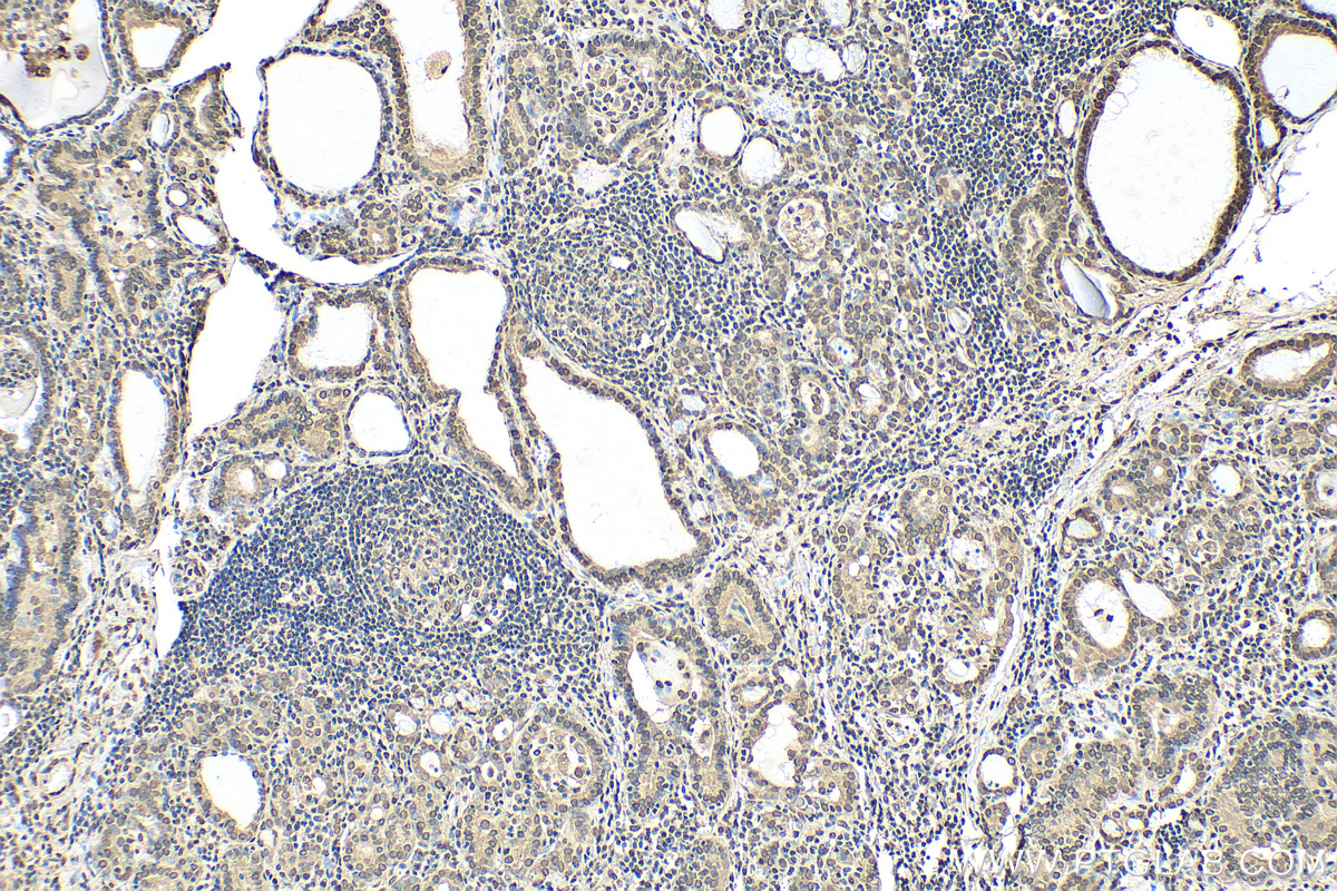 IHC staining of human thyroid cancer using 82888-2-RR (same clone as 82888-2-PBS)