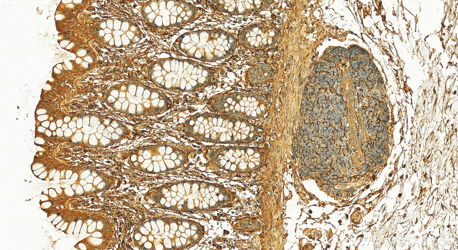 IHC staining of human colon using 10643-1-AP