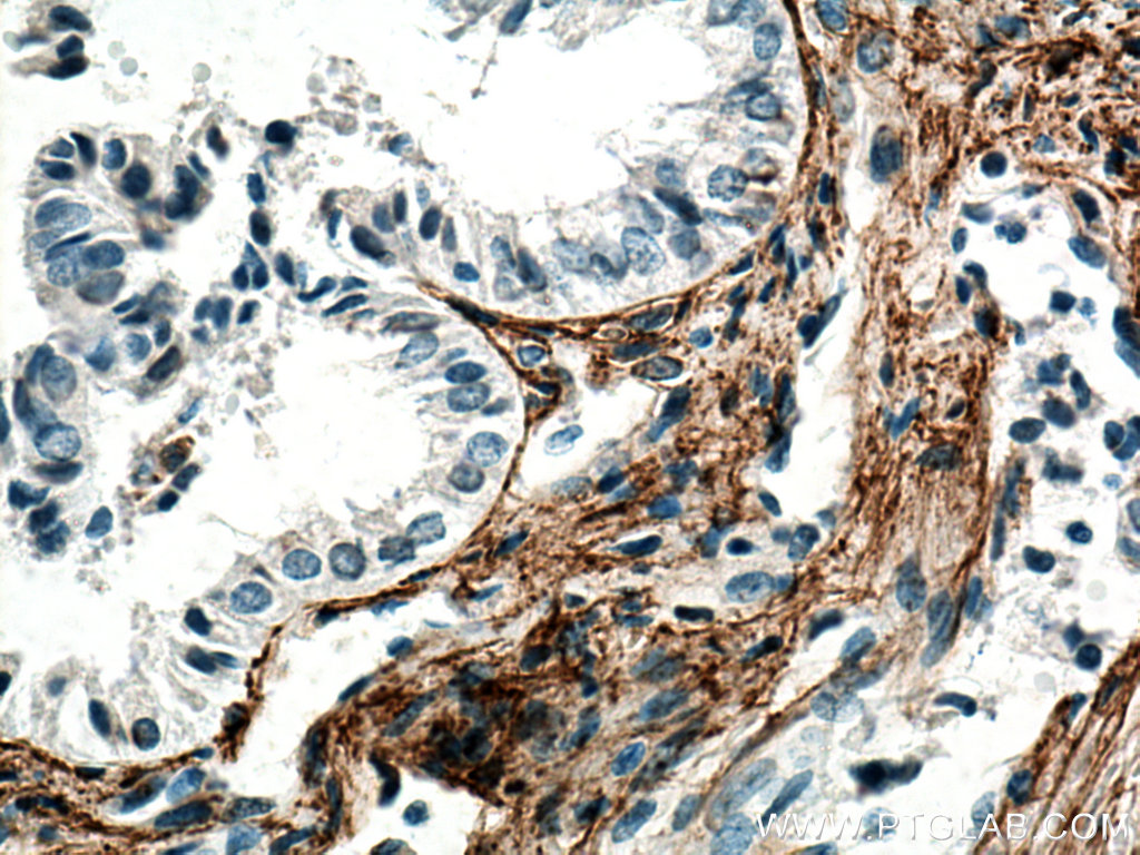 IHC staining of human ovary tumor using 60047-1-Ig (same clone as 60047-1-PBS)