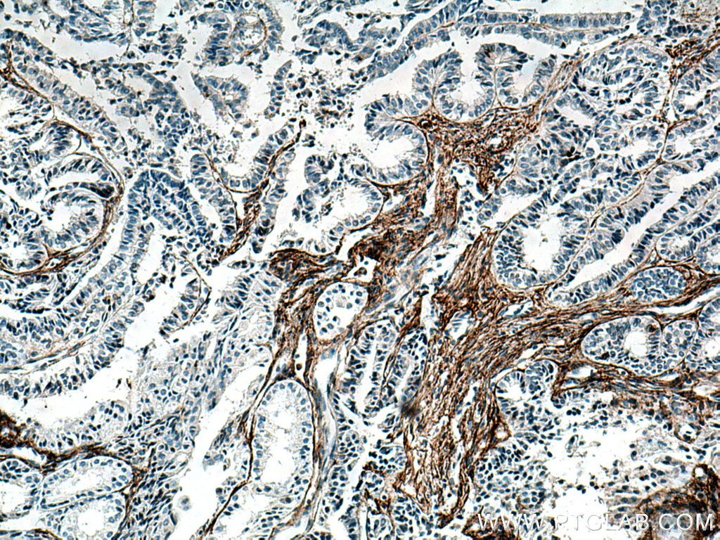 IHC staining of human ovary tumor using 60047-1-Ig (same clone as 60047-1-PBS)