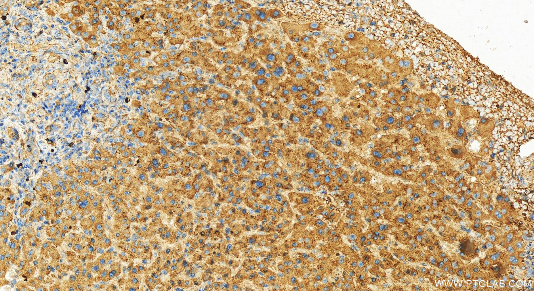 IHC staining of human intrahepatic cholangiocarcinoma using 12765-1-AP