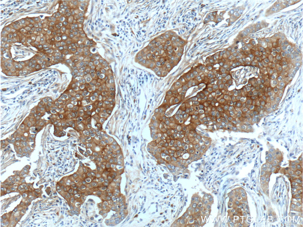 IHC staining of human breast cancer using 26421-1-AP