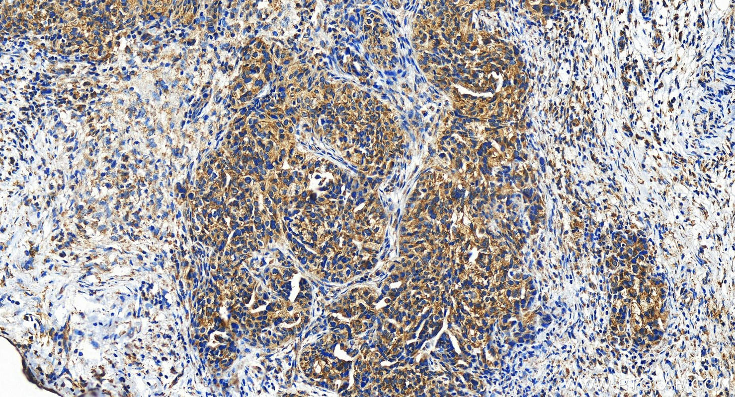 IHC staining of human ovary cancer using 22148-1-AP