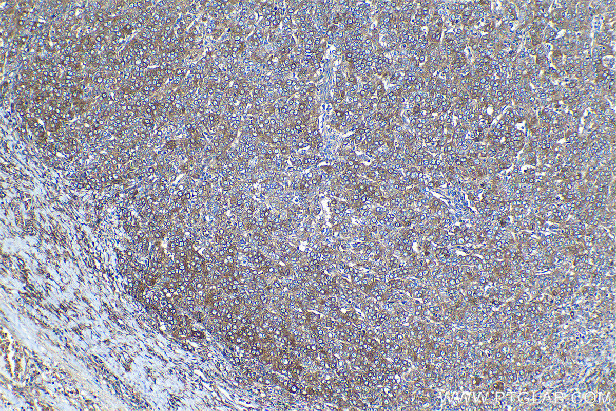 IHC staining of human ovary tumor using 15437-1-AP