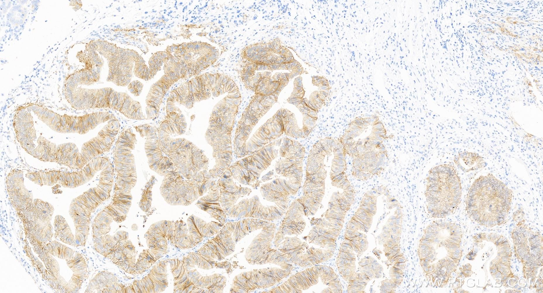 IHC staining of human ovary cancer using 84073-6-RR (same clone as 84073-6-PBS)