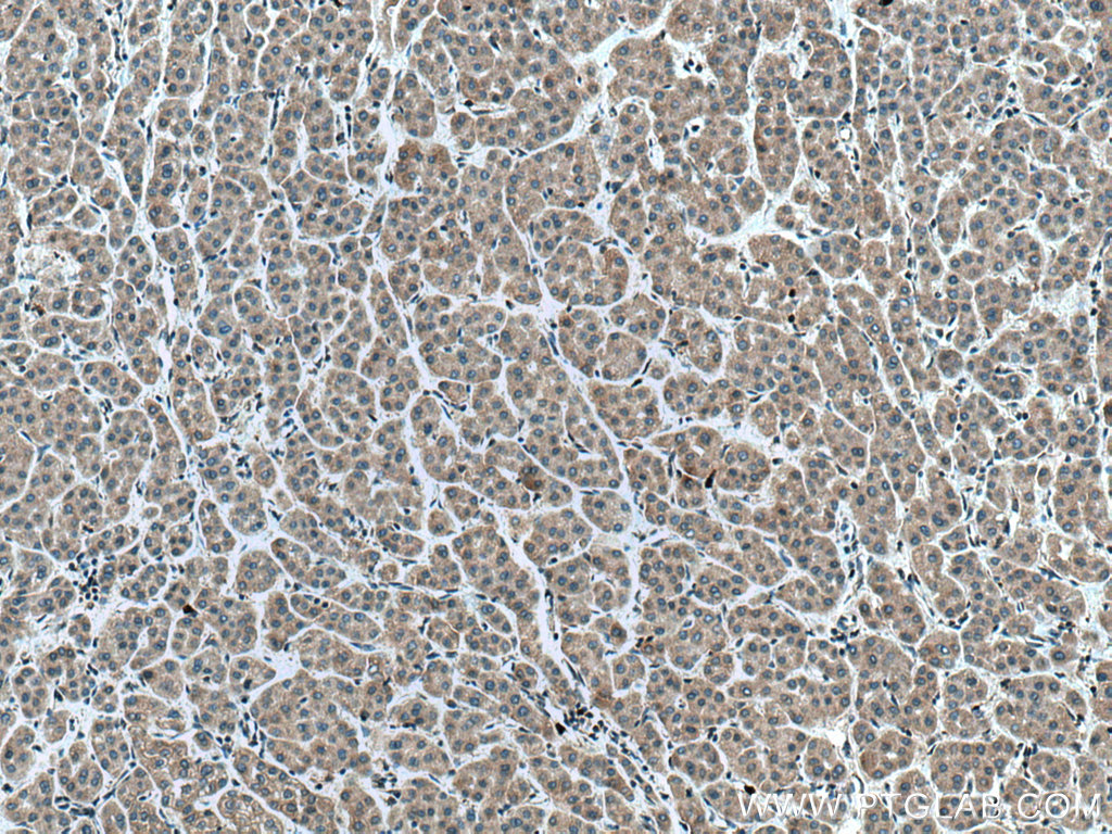 IHC staining of human liver cancer using 18698-1-AP