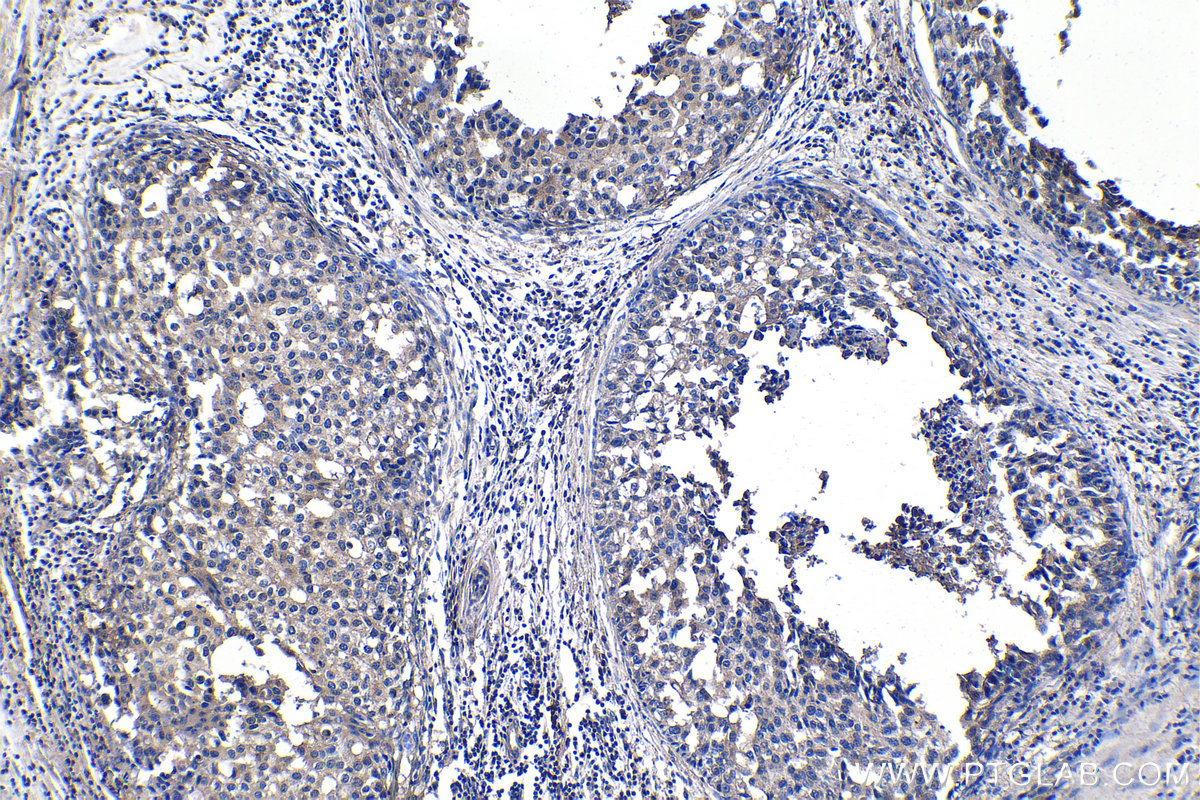 IHC staining of human breast cancer using 67322-1-Ig (same clone as 67322-1-PBS)