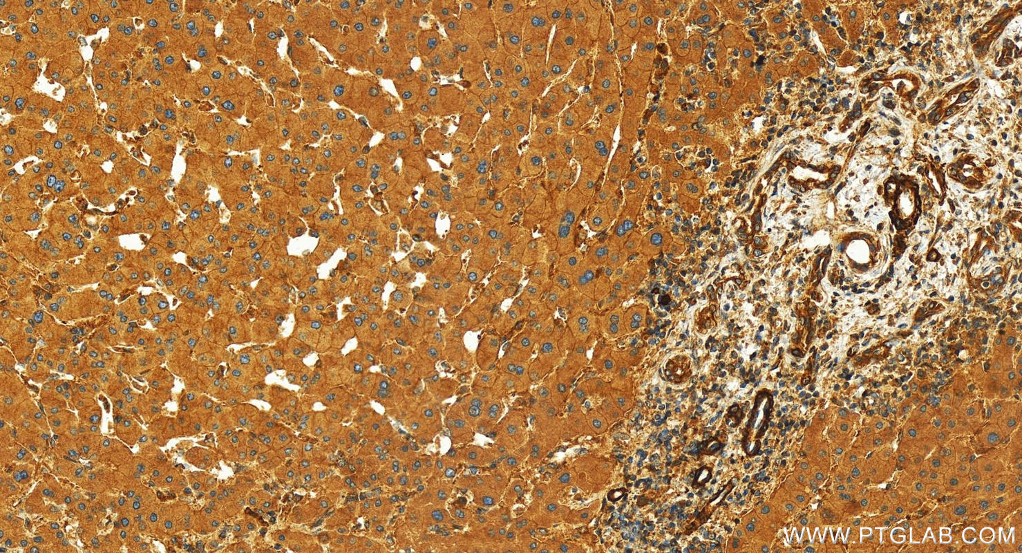 IHC staining of human intrahepatic cholangiocarcinoma using 21243-1-AP