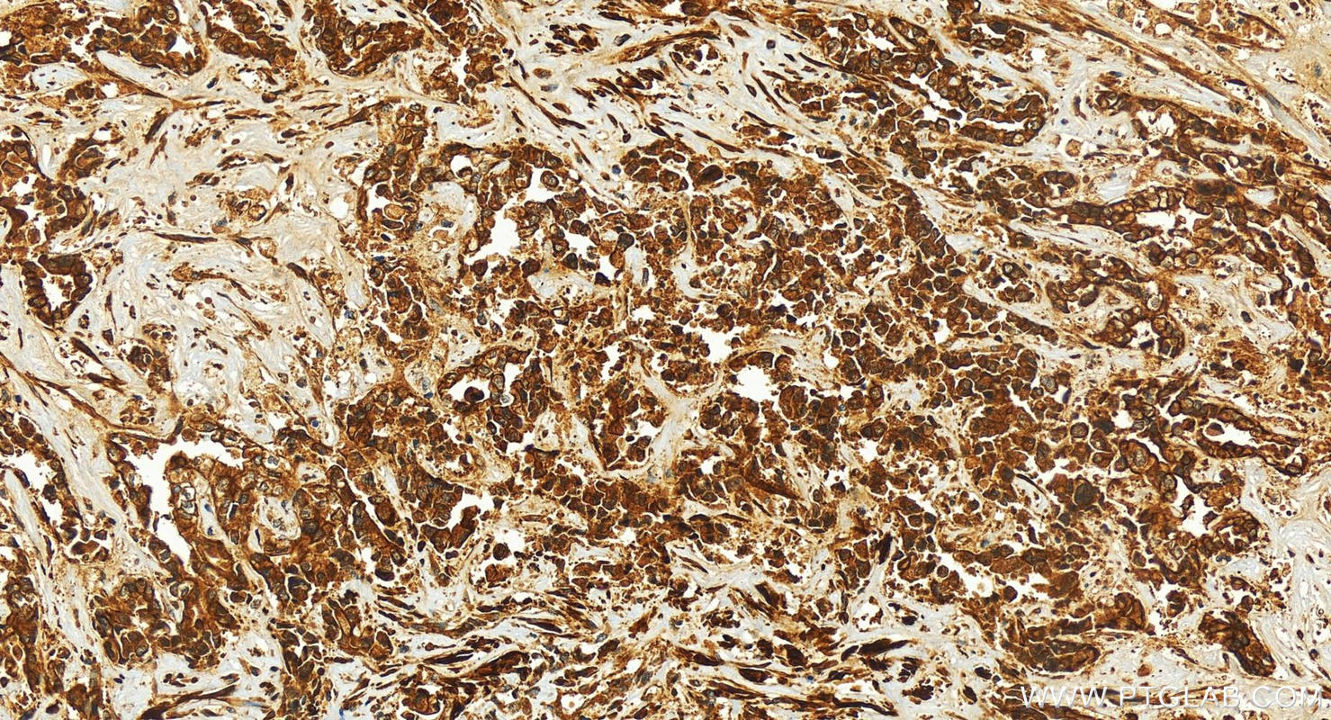 IHC staining of human intrahepatic cholangiocarcinoma using 21243-1-AP