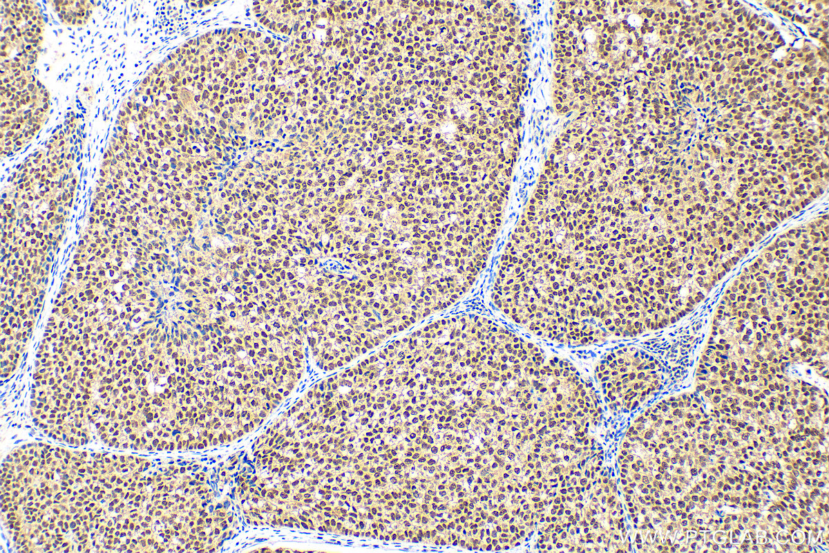 IHC staining of human breast cancer using 20698-1-AP