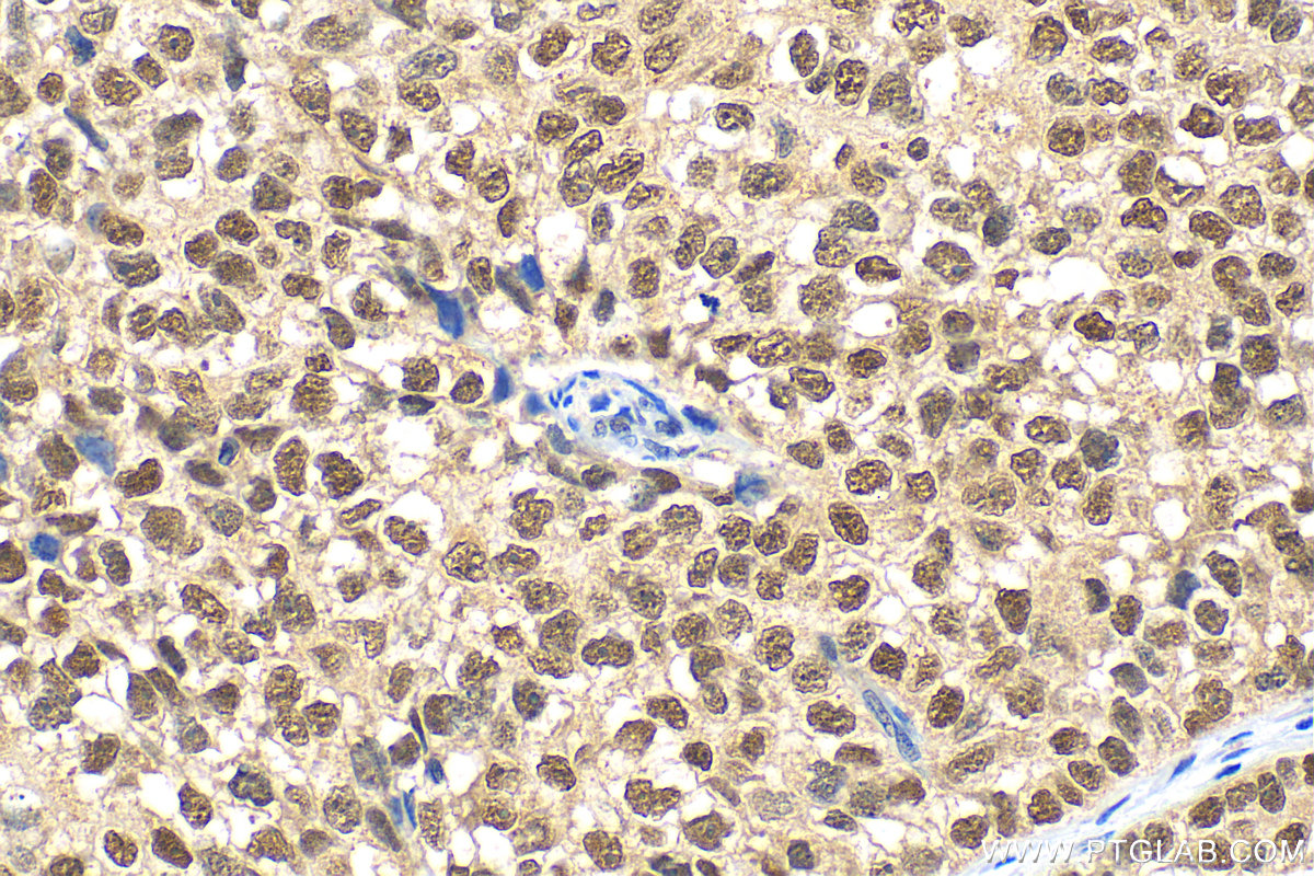 IHC staining of human breast cancer using 20698-1-AP