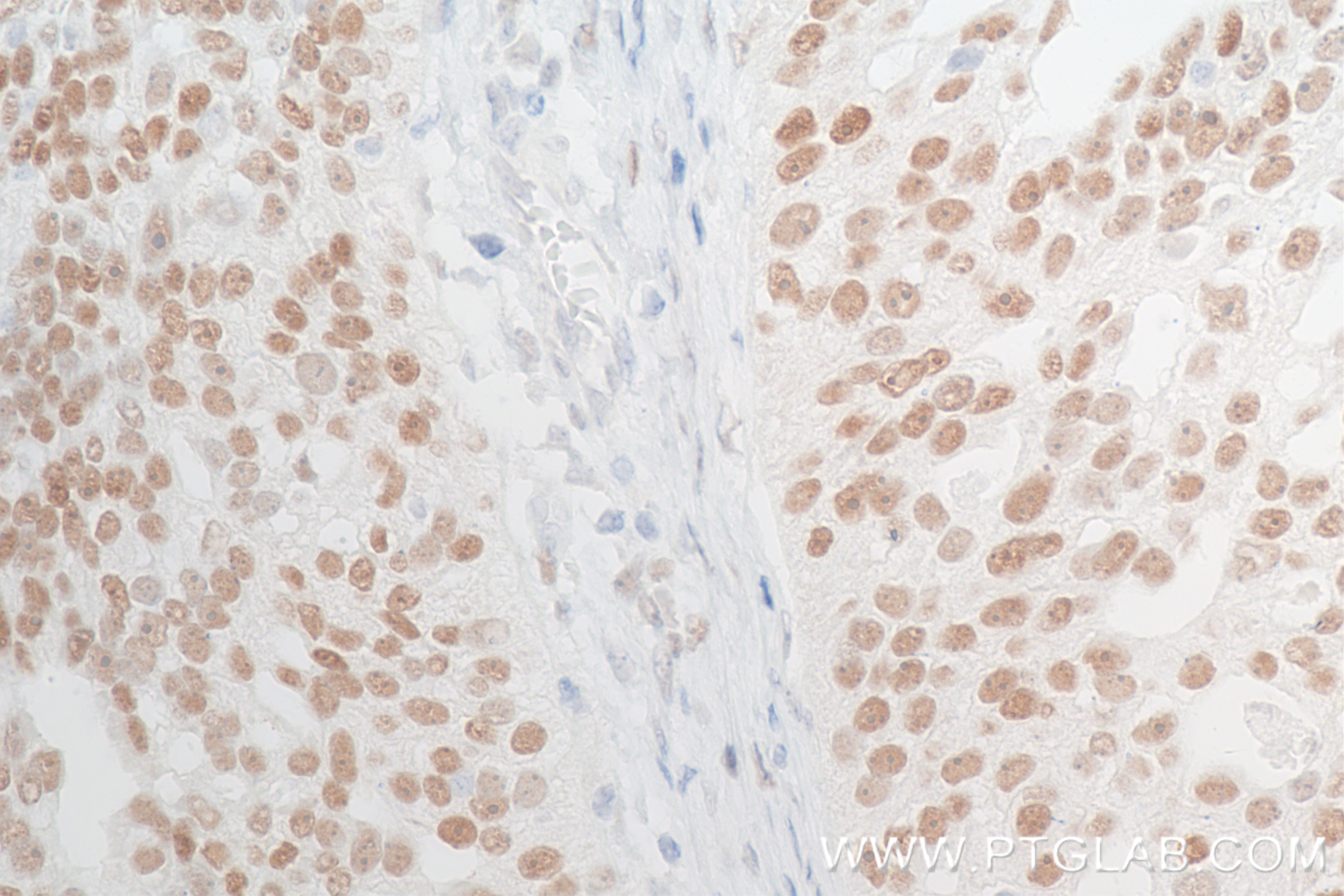 IHC staining of human ovary cancer using 84564-4-RR (same clone as 84564-4-PBS)