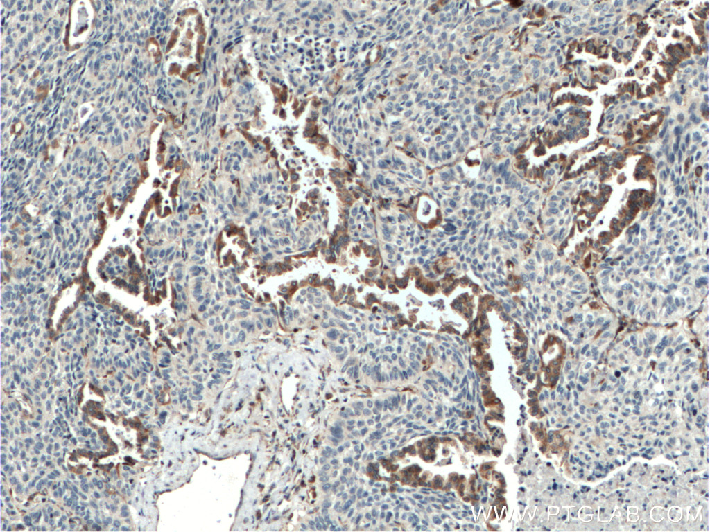 IHC staining of human lung cancer using 14637-1-AP