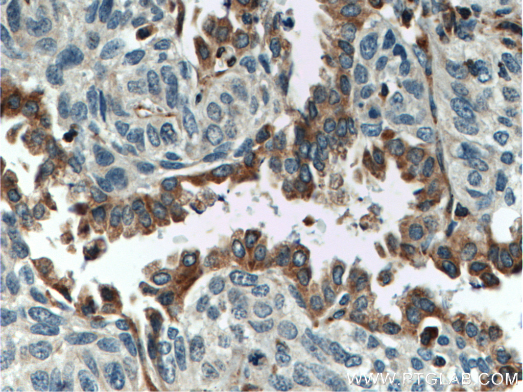 IHC staining of human lung cancer using 14637-1-AP