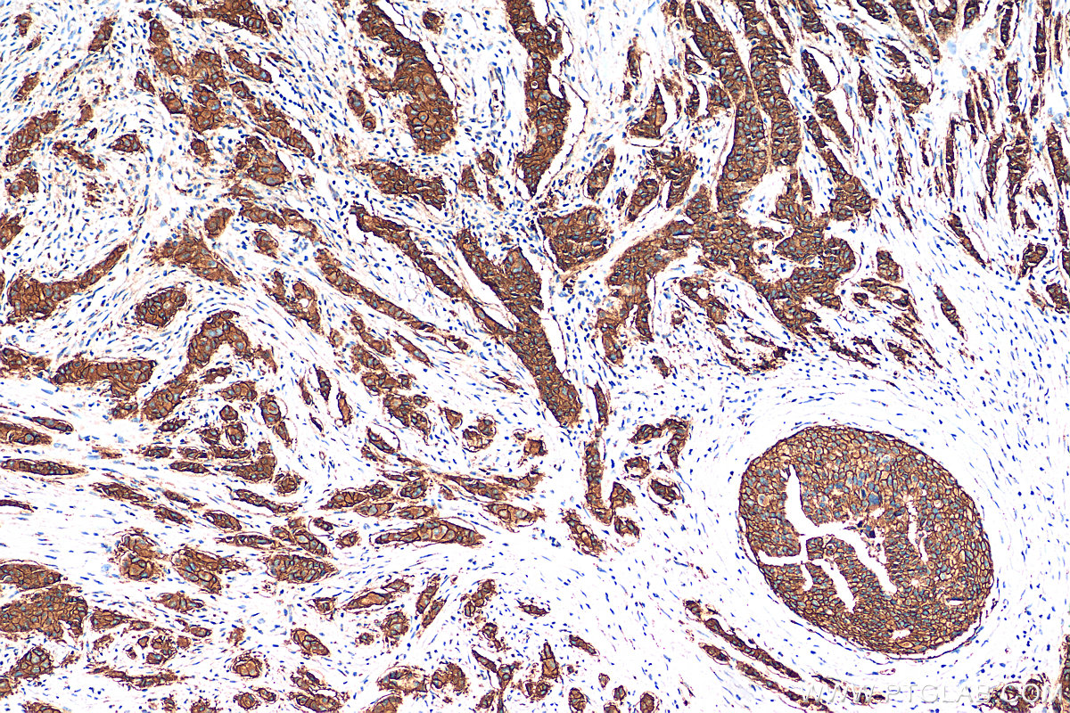 IHC staining of human breast cancer using 18299-1-AP