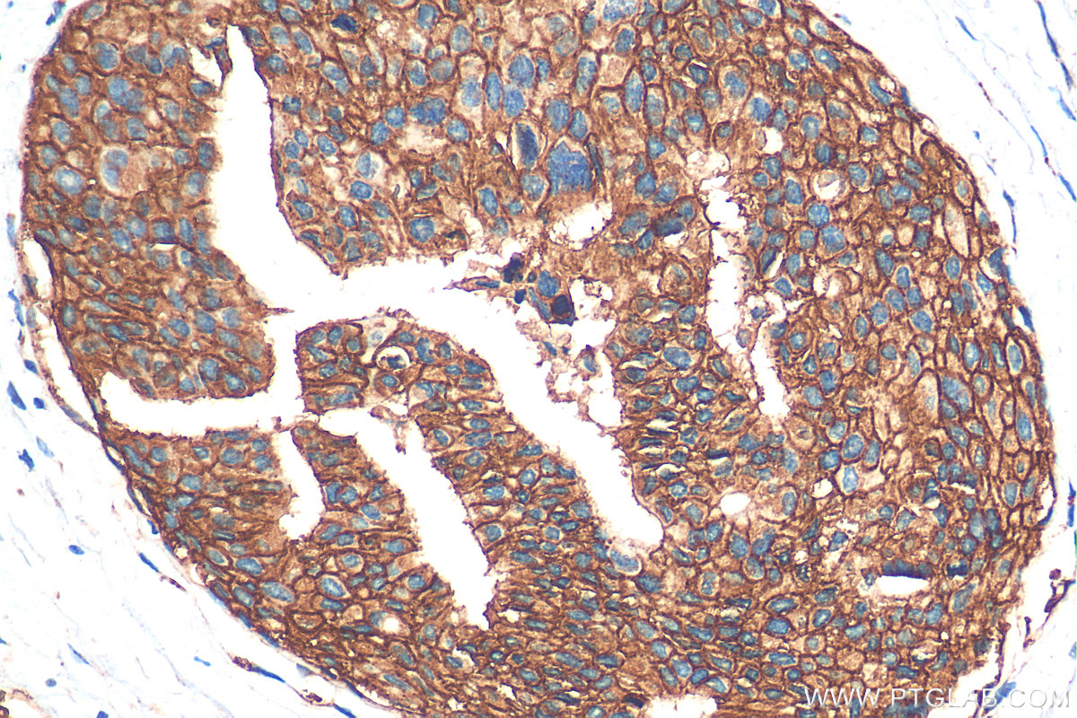 IHC staining of human breast cancer using 18299-1-AP