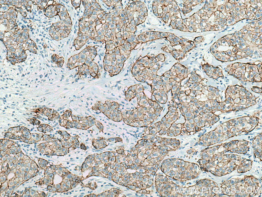 IHC staining of human breast cancer using 60311-1-Ig