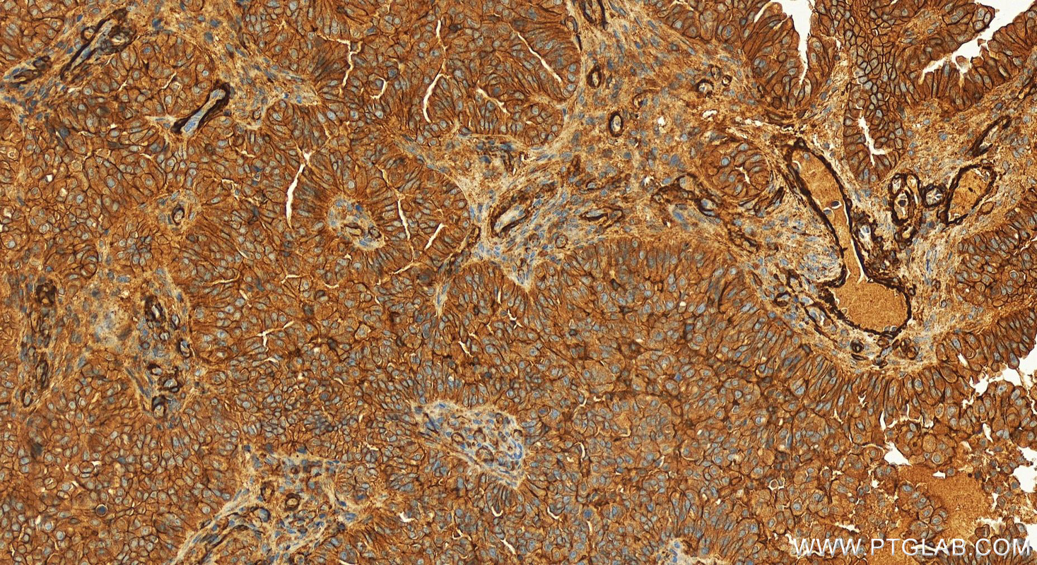 IHC staining of human ovarian  cancer using 84046-1-RR (same clone as 84046-1-PBS)