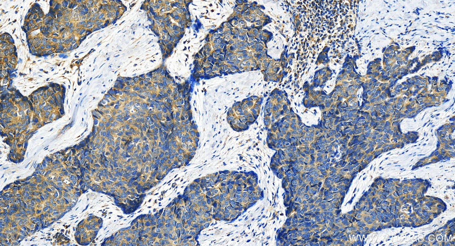 IHC staining of human bowen disease using 21396-1-AP