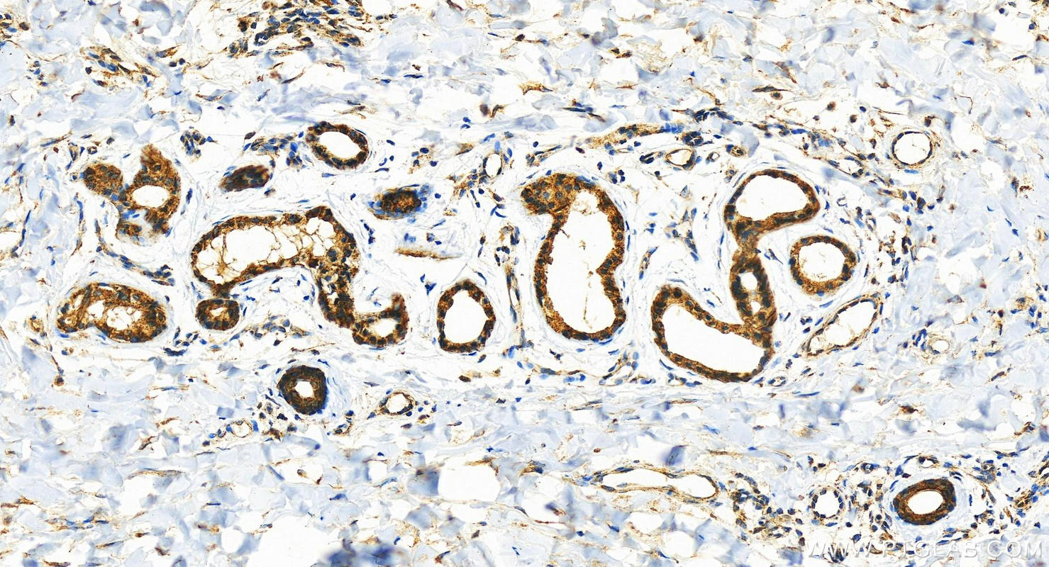 IHC staining of human bowen disease using 21396-1-AP