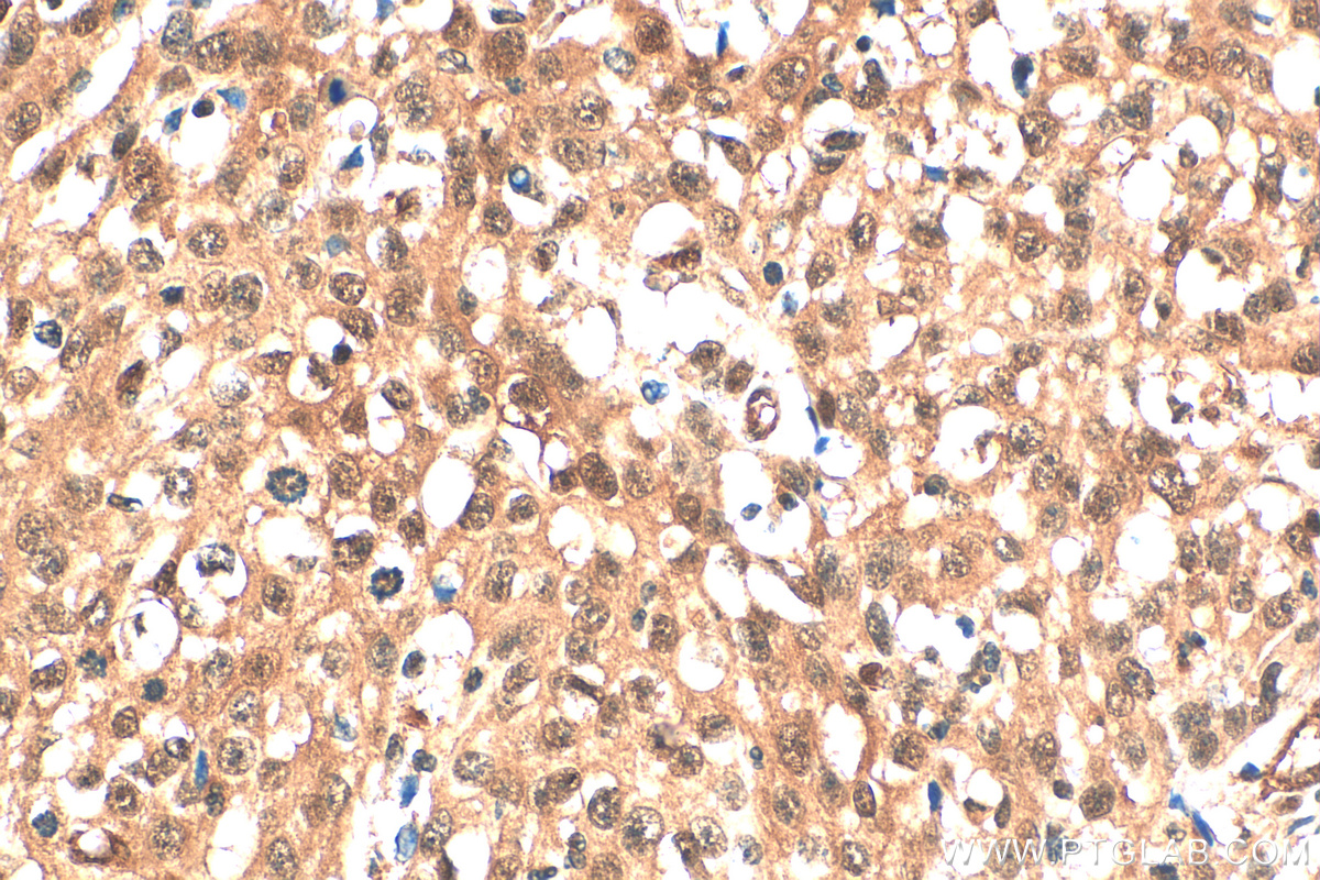 IHC staining of human cervical cancer using 83533-1-RR