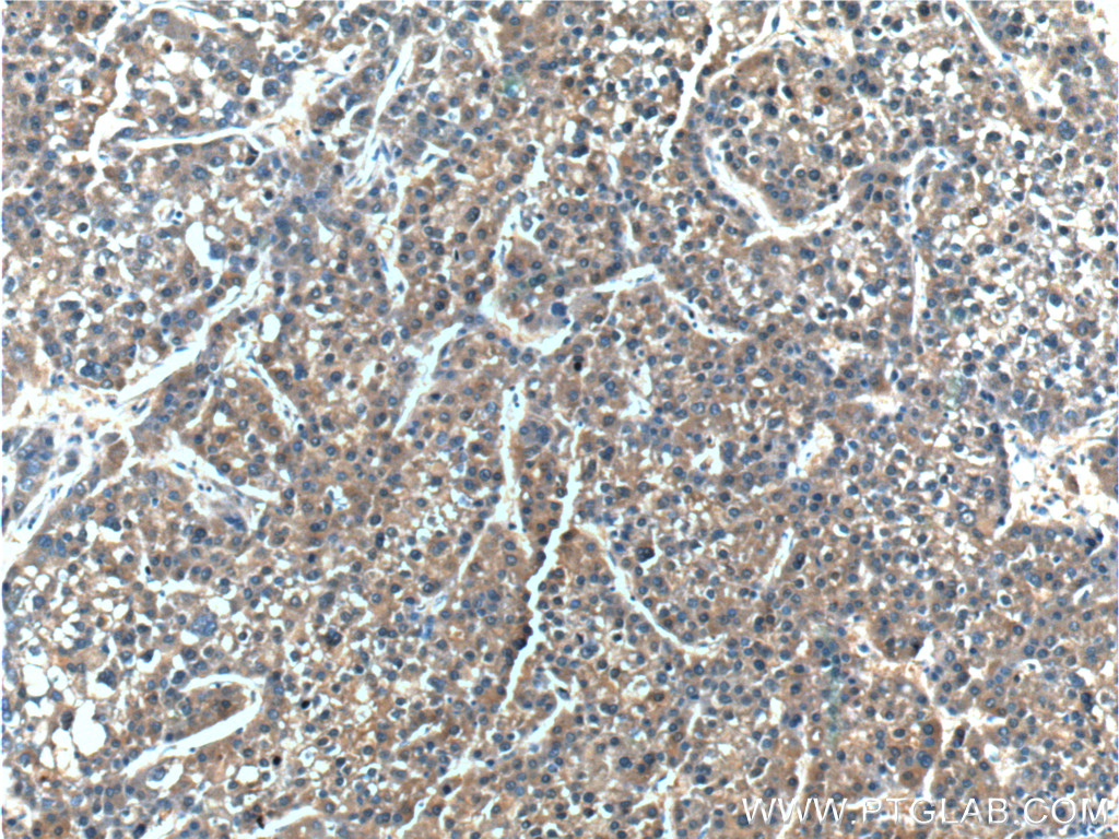 IHC staining of human liver cancer using 14781-1-AP