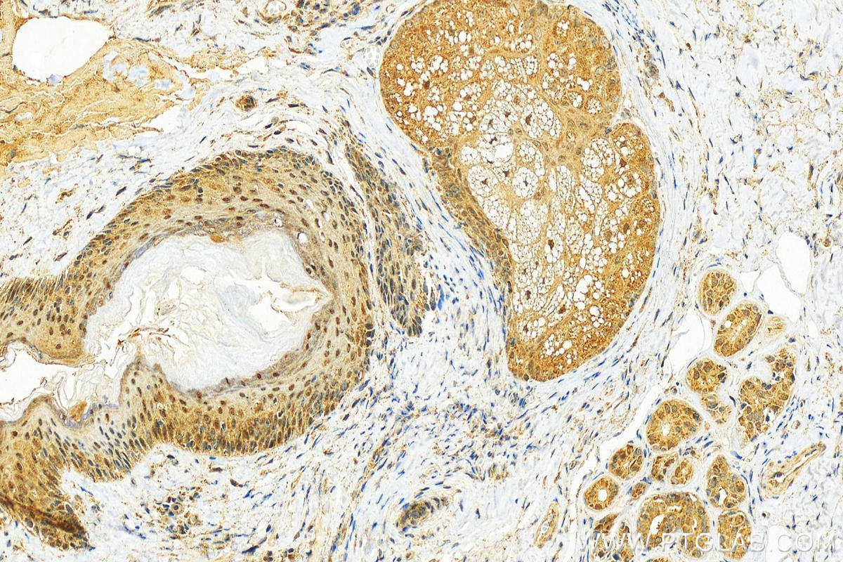 IHC staining of human skin cancer using 23525-1-AP