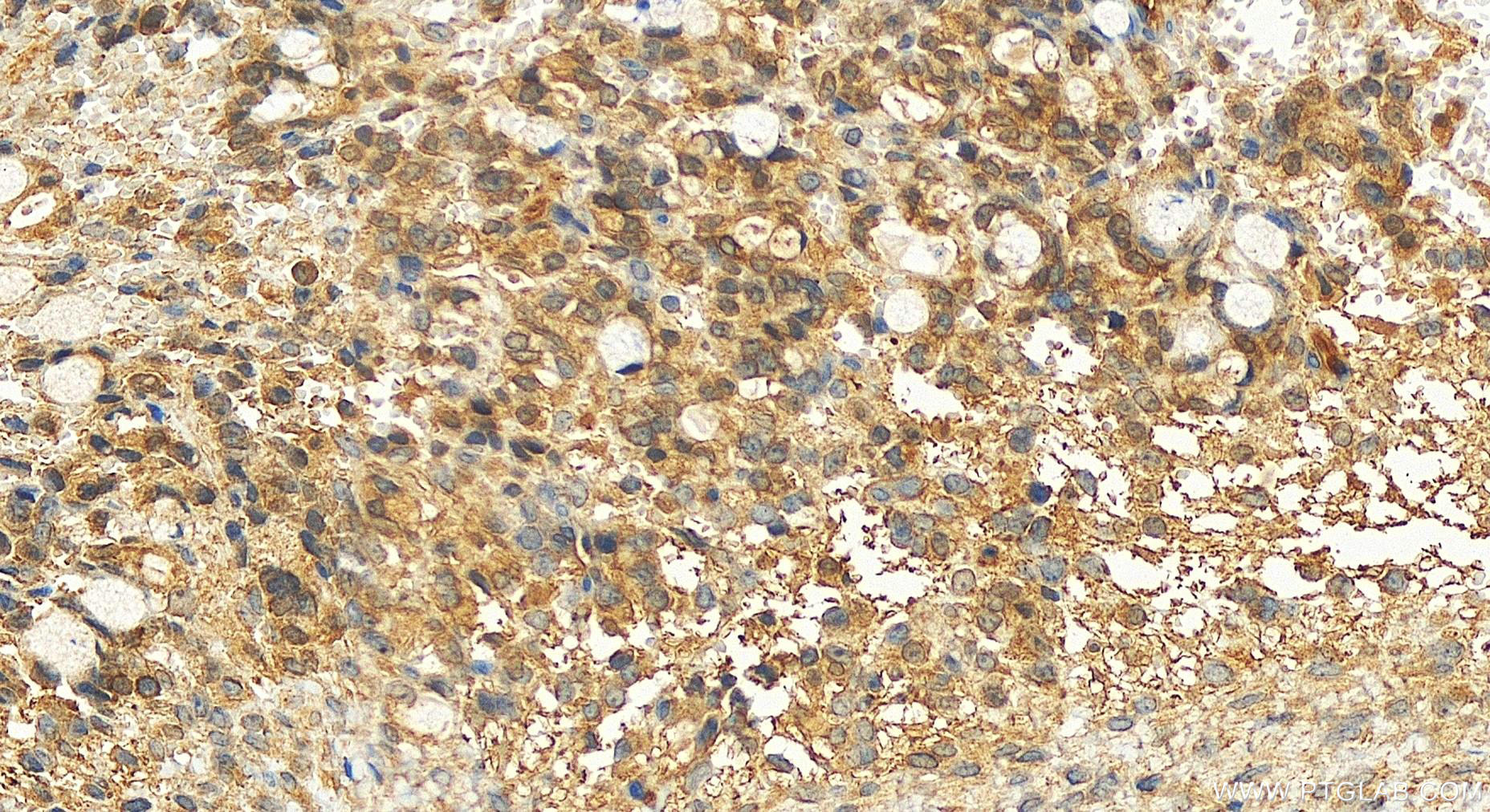 IHC staining of human ovary cancer using 20717-1-AP