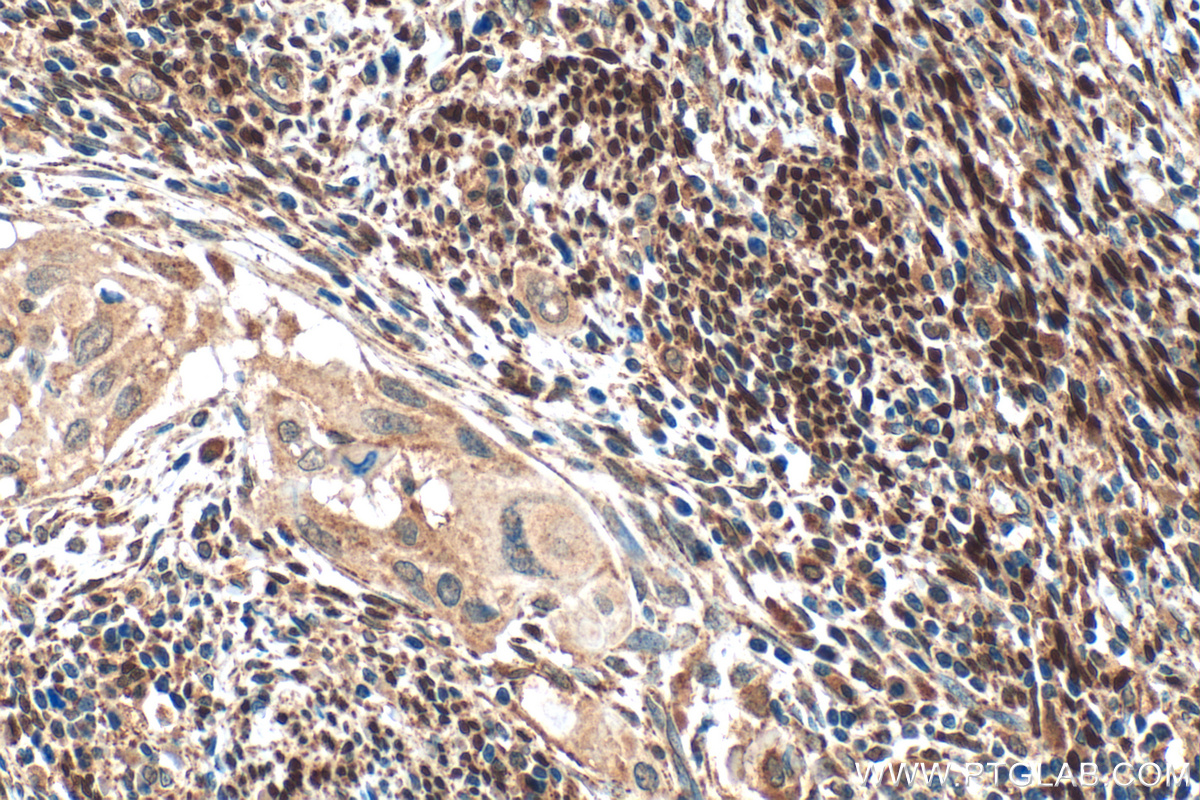 IHC staining of human cervical cancer using 21244-1-AP