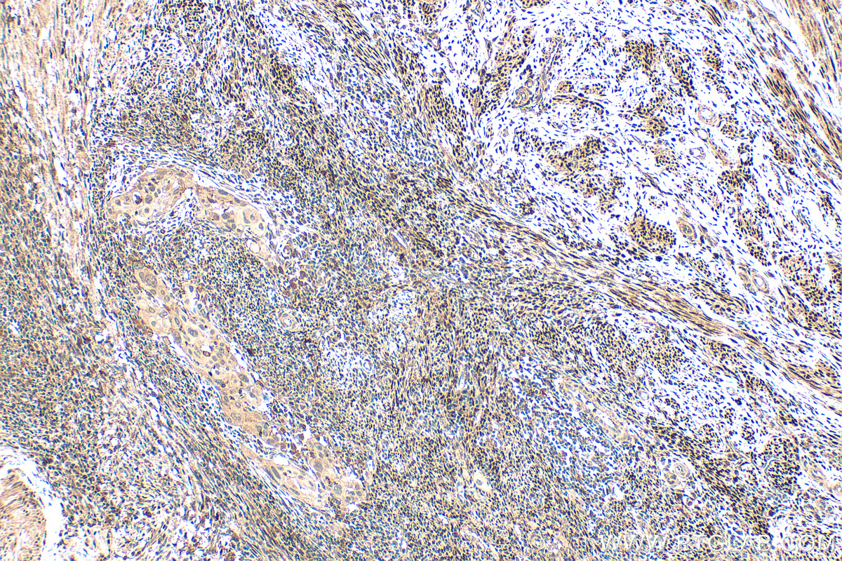 IHC staining of human cervical cancer using 21244-1-AP