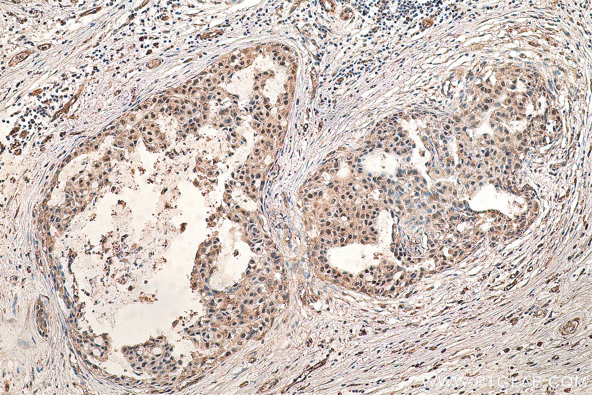 IHC staining of human breast cancer using 23117-1-AP (same clone as 23117-1-PBS)