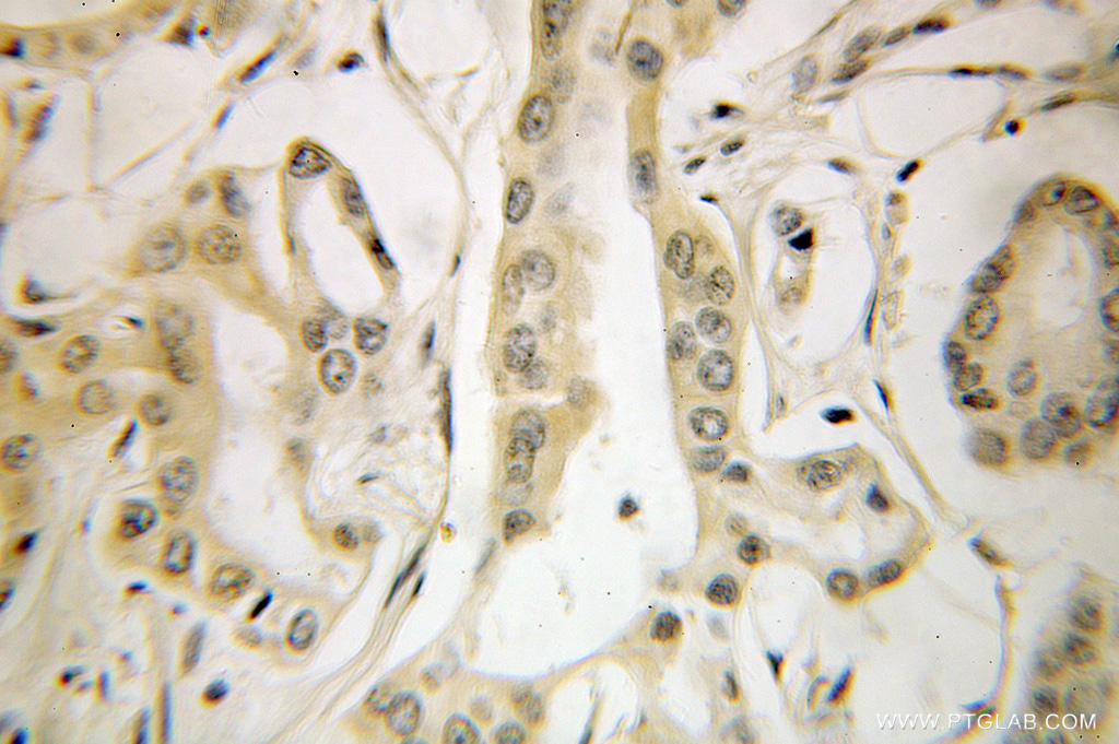 IHC staining of human pancreas cancer using 10884-1-AP