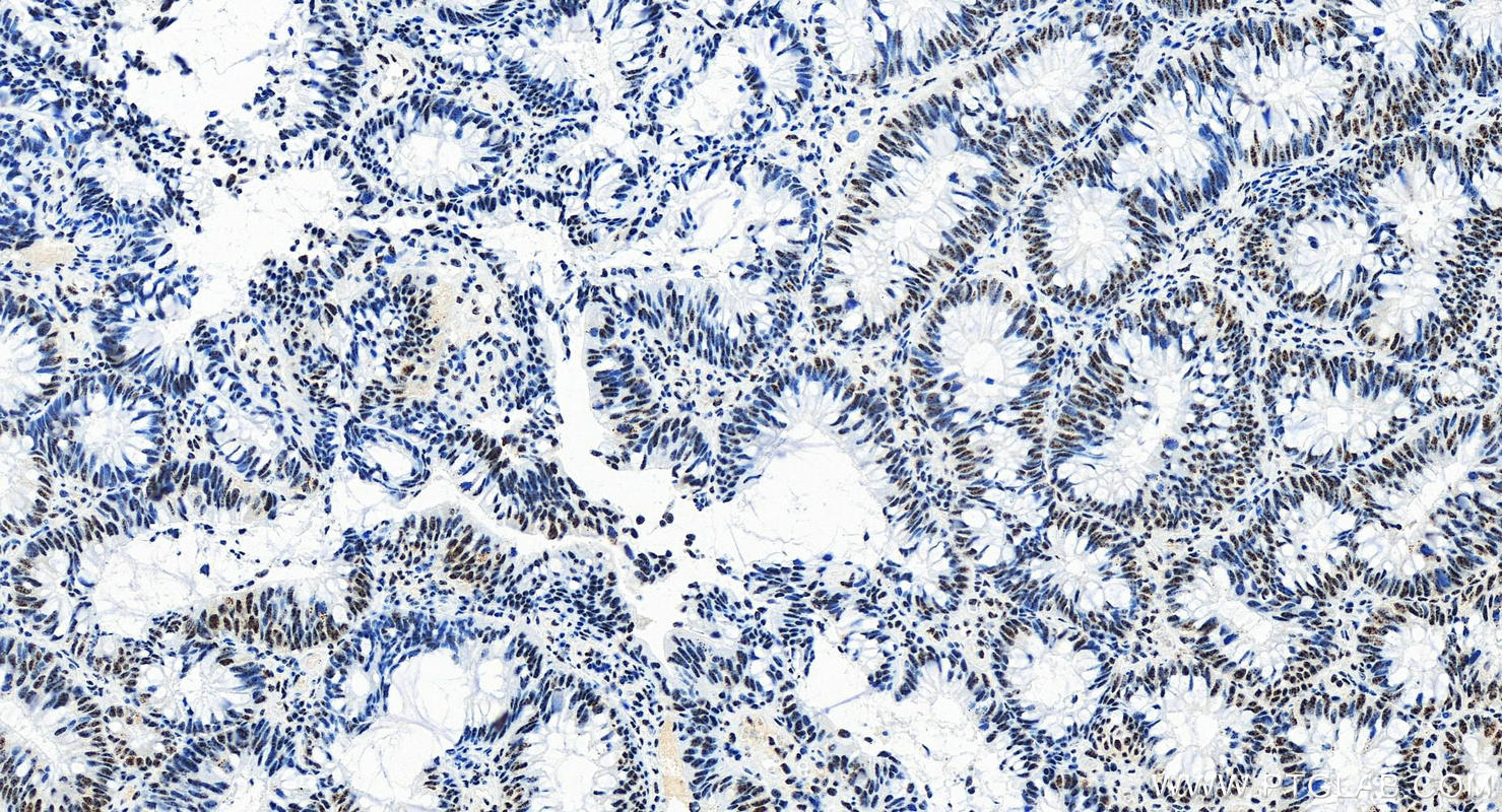 IHC staining of human colon cancer using 83891-6-RR (same clone as 83891-6-PBS)