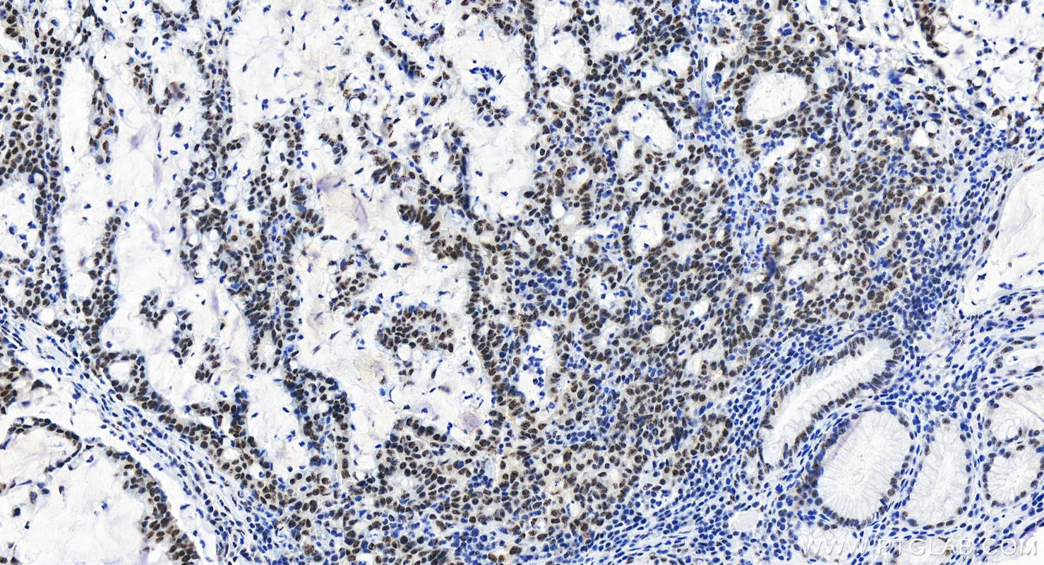 IHC staining of human stomach cancer using 83891-6-RR (same clone as 83891-6-PBS)