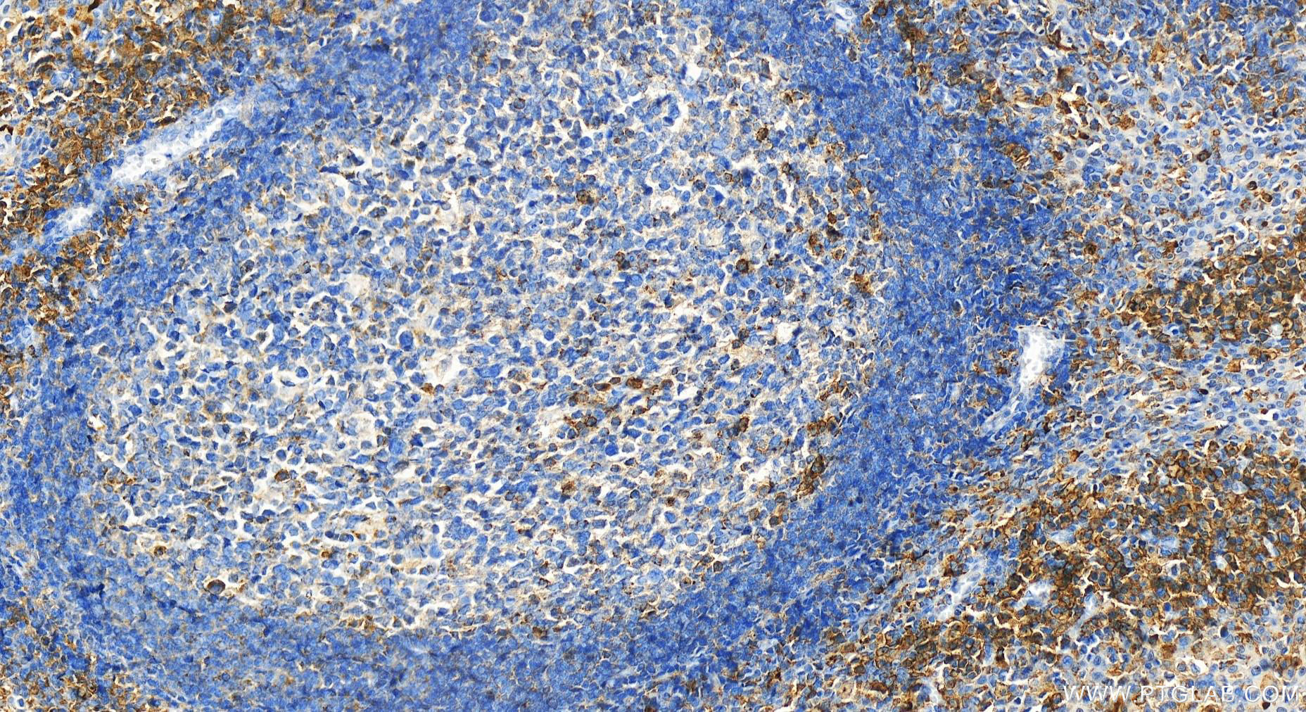 IHC staining of human tonsillitis using 24891-1-AP